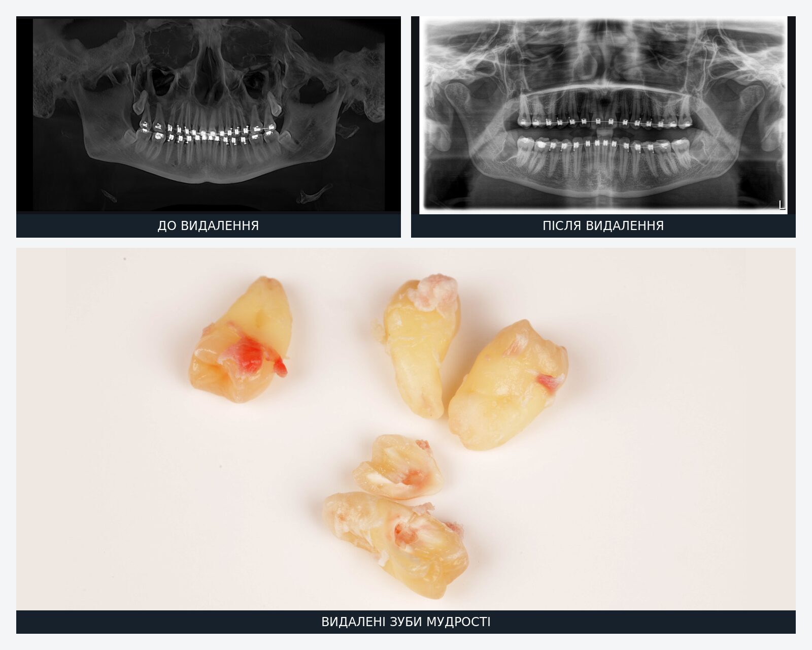 Panoramic X-rays with braces before and after removal of four wisdom teeth in Lviv, plus a photo of the extracted teeth