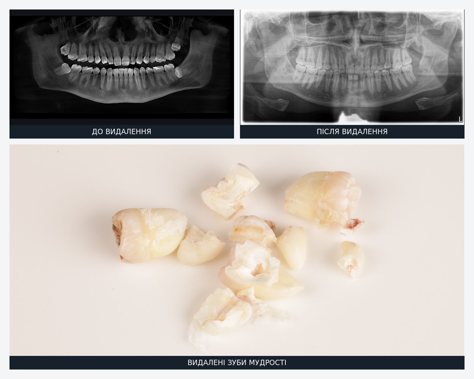Removal of four wisdom teeth in Lviv: X-rays before and after surgery, with extracted teeth and fragments