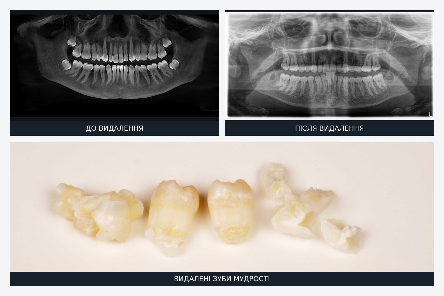 Removal of four wisdom teeth in Lviv — X-rays before and after surgery