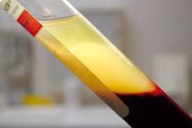 Тромбоцити збагачені фібрином ( PRF ) - замість штучної кістки!