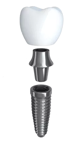 Сколько времени длится имплантация зубов