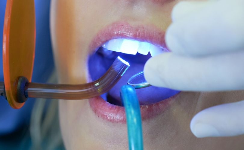 Для чого ставлять пломби: детальніше про роботу стоматологів