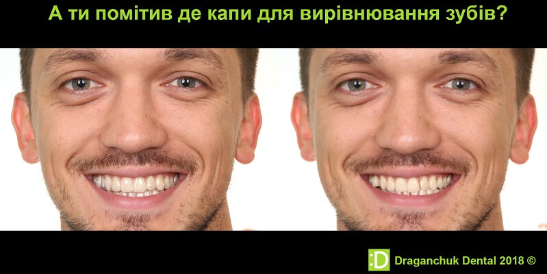 Неправильний прикус після встановлення пломби: як виникає і що робити