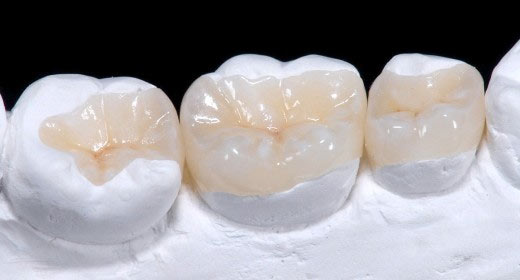 Як підібрати правильний колір пломби