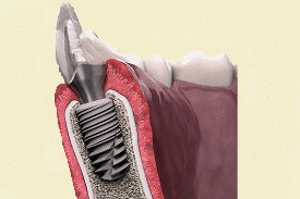 Зубні імпланти нового покоління