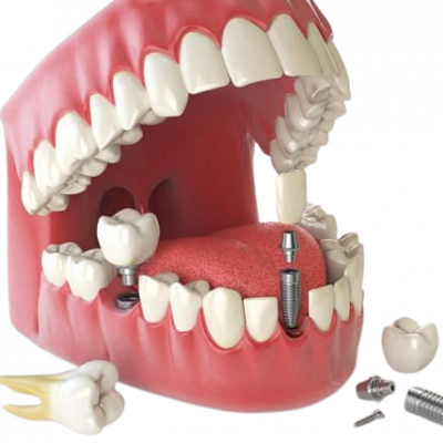 Як відбувається імплантація зубів