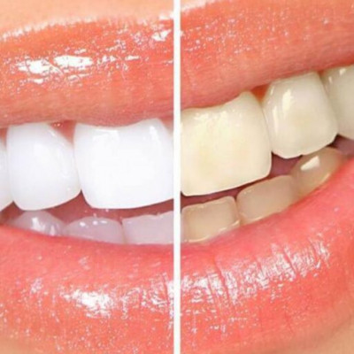 Чи можна поставити вініри, якщо немає зубів?