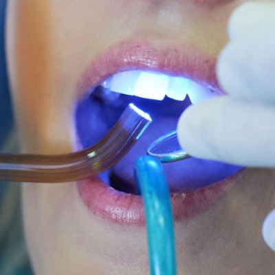 Для чого ставлять пломби: детальніше про роботу стоматологів