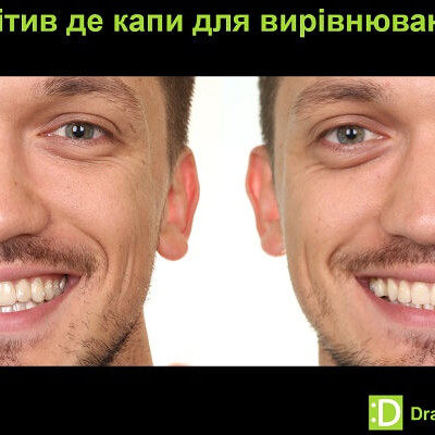 Неправильний прикус після встановлення пломби: як виникає і що робити