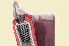 Зубні імпланти нового покоління