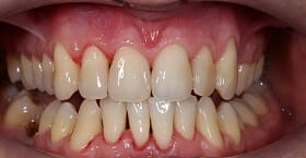 Чутливість зубів