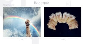 Питання - відповідь - Видалення зуба мудрості: рвати чи не рвати?