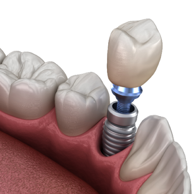 Что нельзя делать после имплантации зубов