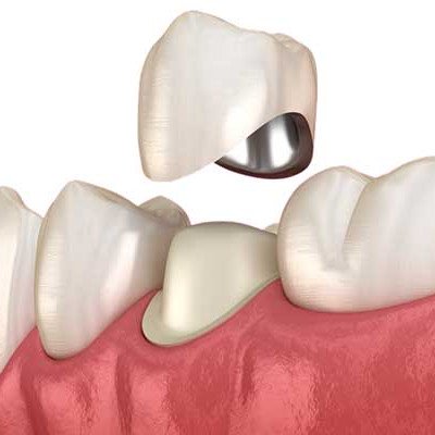 Чем отличаются виниры от коронок