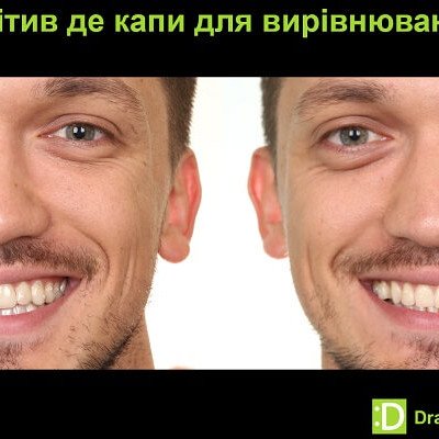 Неправильный прикус после установки пломбы: как возникает и что делать