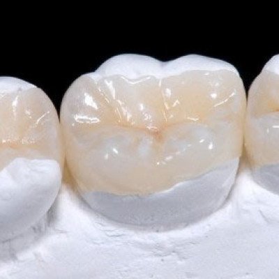 Как подобрать правильный цвет пломбы