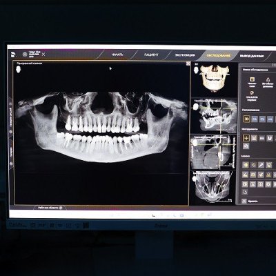 Зубная имплантация Львов