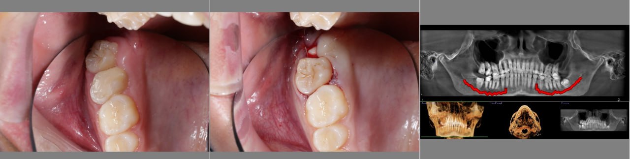 Трансплантація зубів у Львові 1
