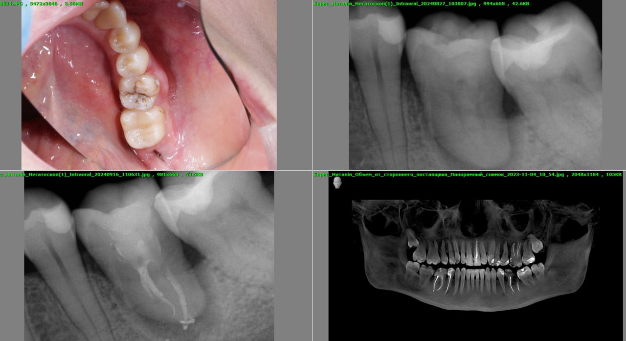 Трансплантація зубів у Львові 2