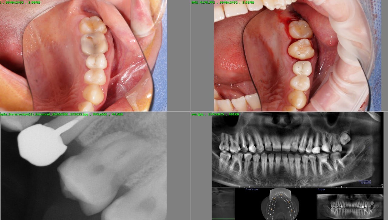 Трансплантація зубів у Львові 3