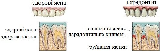 Сравнение здоровых дёсен и кости с пародонтальным карманом и потерей костной ткани